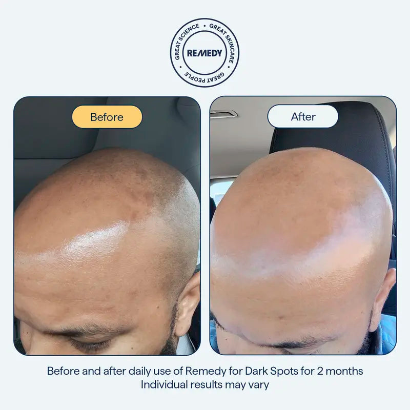 REMEDY for dark spots