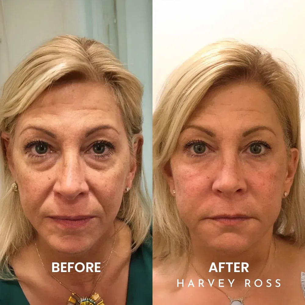 🏆#1 Bestselling🏆Harvey Ross - Instant Lift+