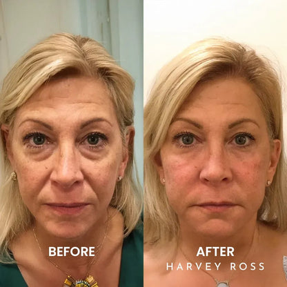 🏆#1 Bestselling🏆Harvey Ross - Instant Lift+