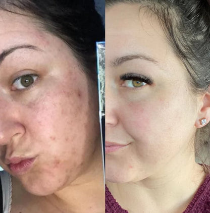 🔥🎁LAST DAY 49% OFF🔥Arbutin 7% + Tranexamic Acid 4% Cream