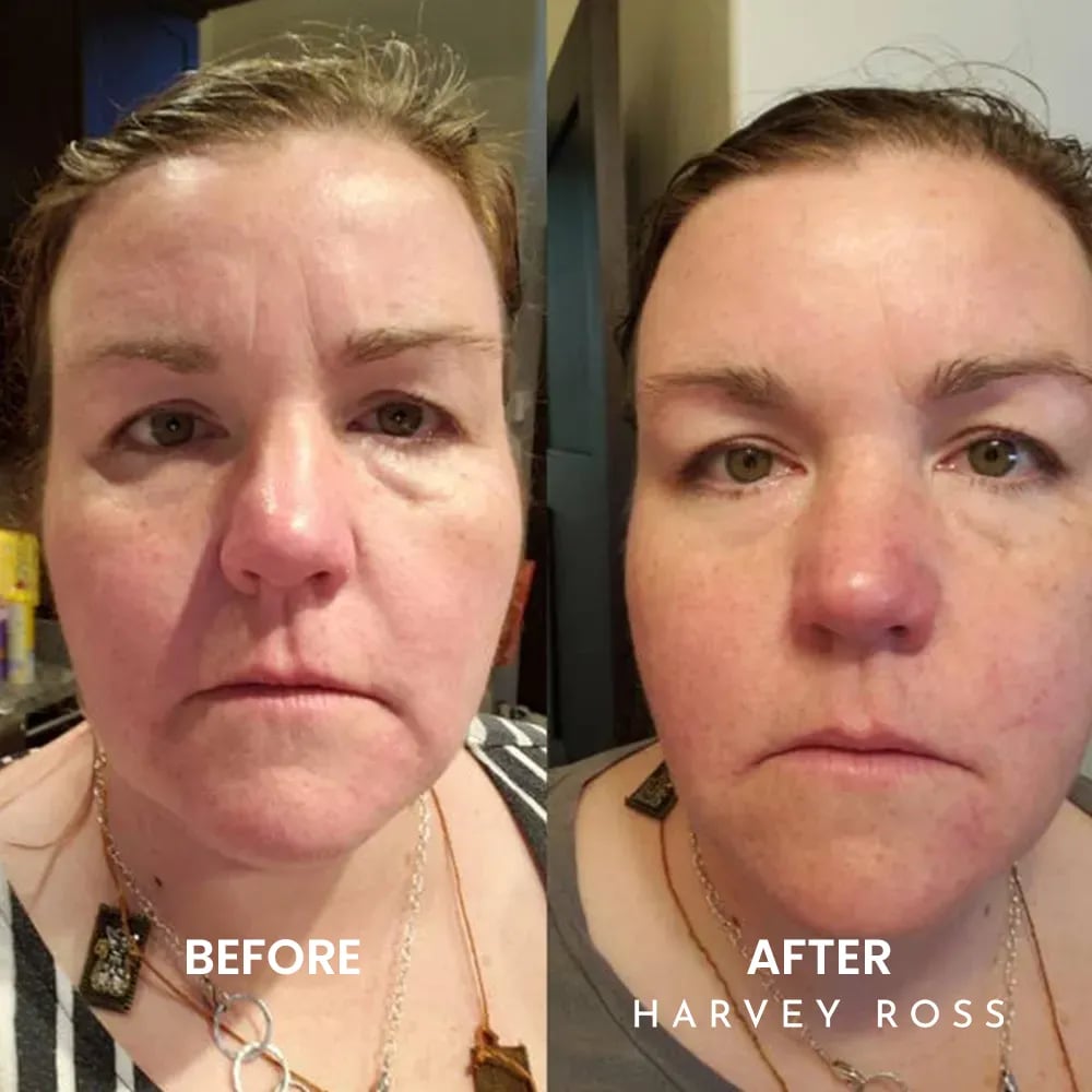 🏆#1 Bestselling🏆Harvey Ross - Instant Lift+