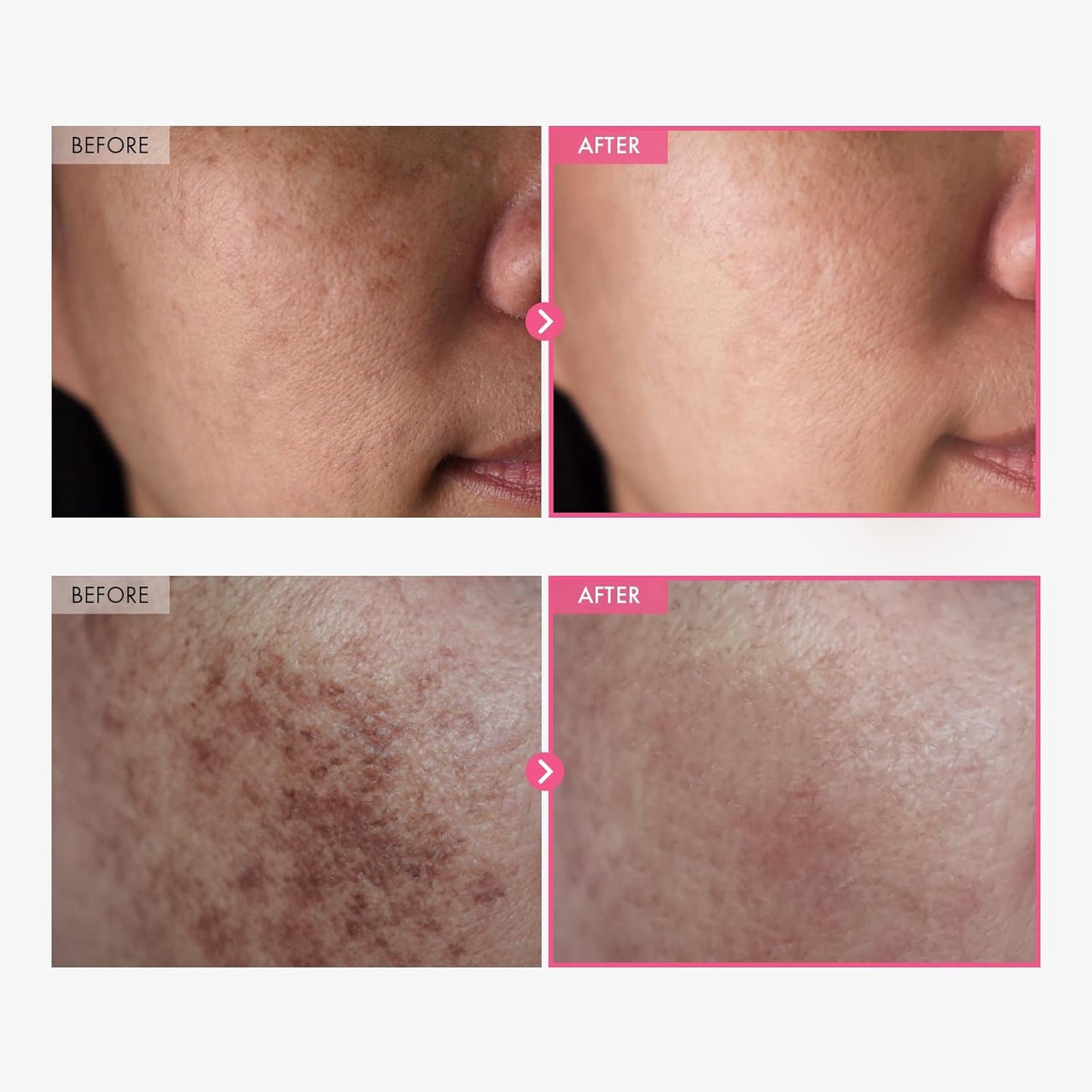 🔥🎁LAST DAY 49% OFF🔥Arbutin 7% + Tranexamic Acid 4% Cream